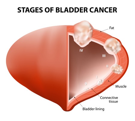 Actos Bladder Cancer